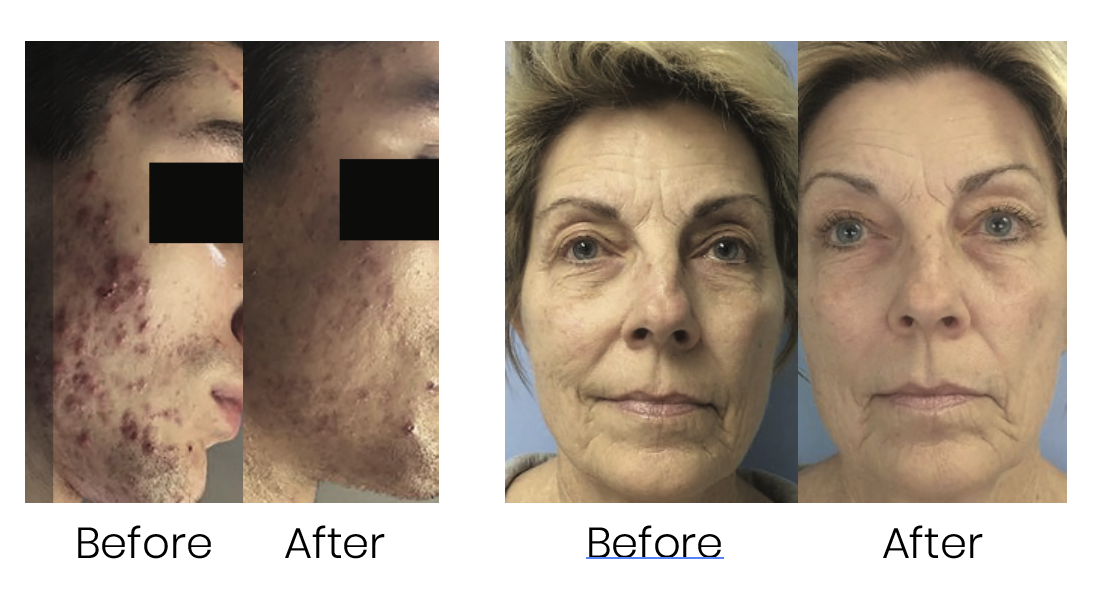 Before After Celluma Light Therapy