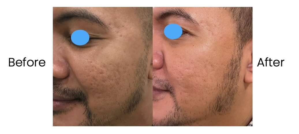 Derma Smoothing Before After