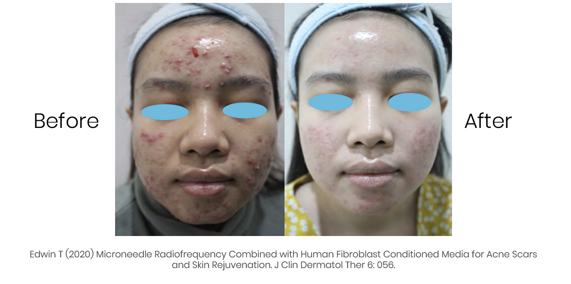Derma Smoothing Before After