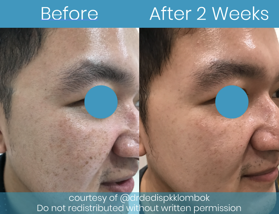 Korean Peel Laser Before After
